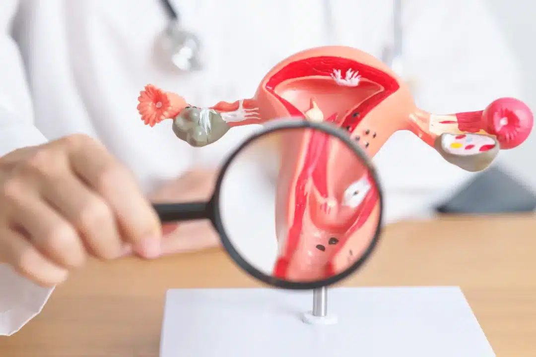 Endometriosis and Fertility