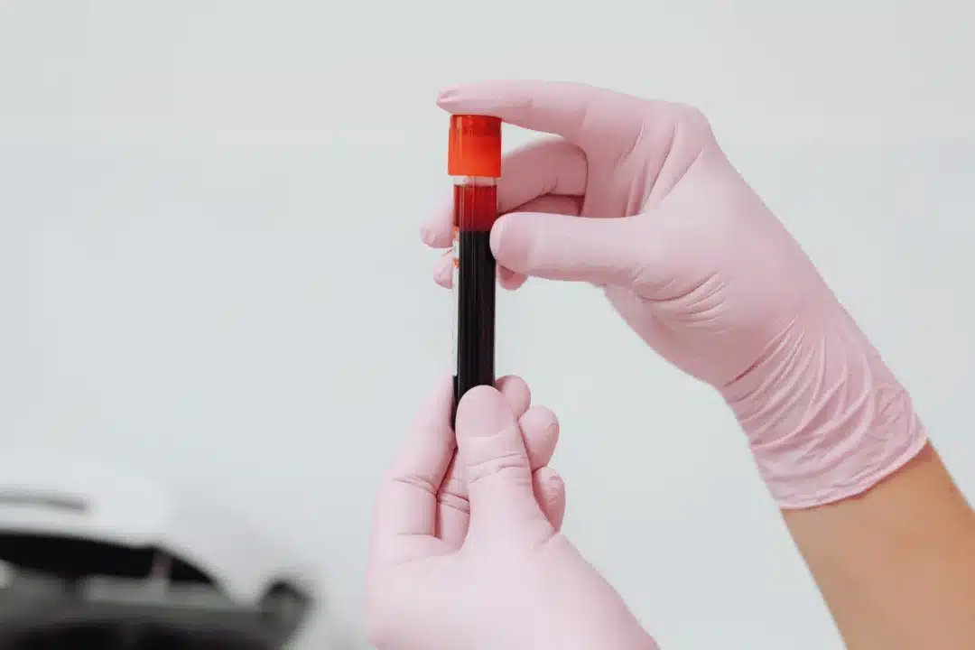 How Thalassemia Affects Fertility in Men and Women