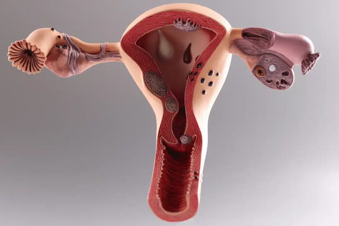 HyCoSy or HSG in testing uterine and fallopian tube health?